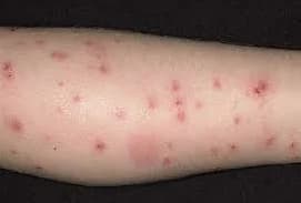 Bed bug bites in a line pattern — often the first sign of an infestation at home. Bed bug bite marks on an arm showing typical clustered pattern
