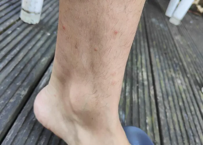 Flea bites concentrated on the lower leg and ankle — a common pattern. Flea bites on a human lower leg and ankle — typical bite pattern from floor-level fleas