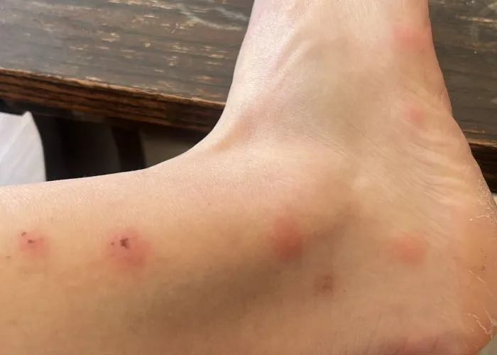 Flea bites typically appear around the ankles and feet in clusters. Flea bites on a human foot and ankle showing red, swollen welts