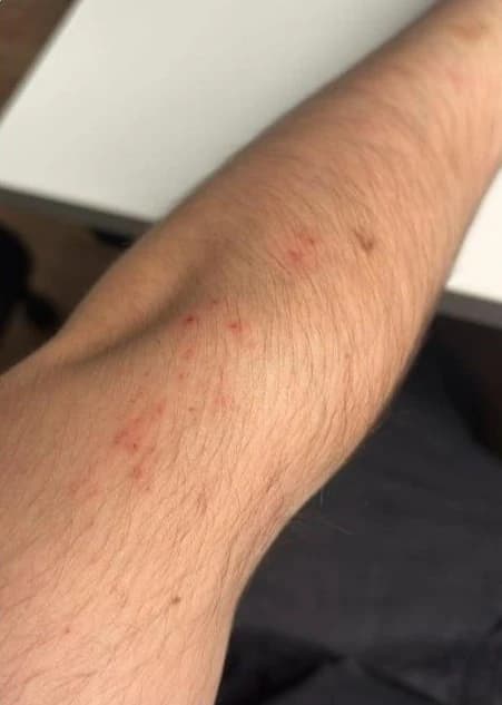 Persistent flea bites like these are a sign it is time to call a professional. Flea bites on a human arm showing red, irritated welts